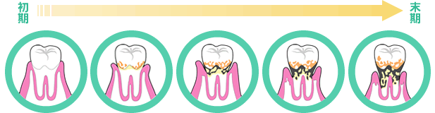 歯周病の進行度の図